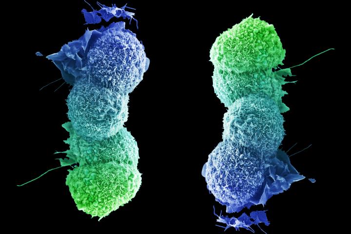 Lung cancer cell, full credit to LRI EM department.