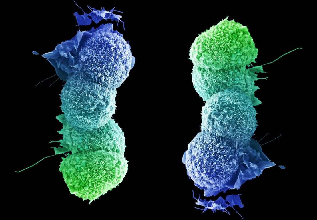 Lung cancer cell, full credit to LRI EM department.