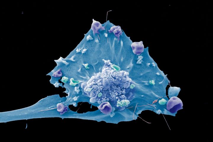 Colour-enhanced microscopy image of a breast cancer cell.