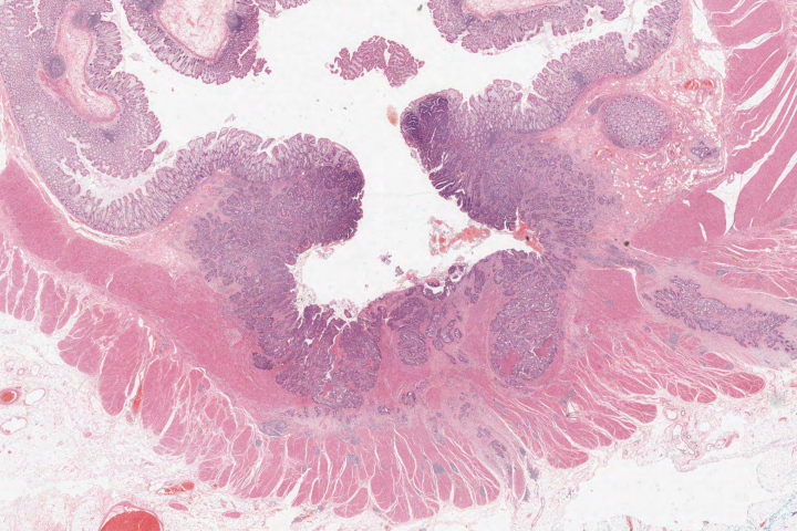 cross section though the wall of the large bowel showing an ulcerated cancer growing through the bowel wall and having invaded a large vein