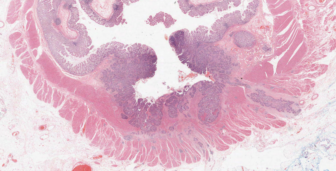 cross section though the wall of the large bowel showing an ulcerated cancer growing through the bowel wall and having invaded a large vein